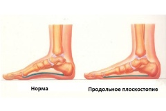 Костный бульон при плоскостопии для здоровых суставов и связок